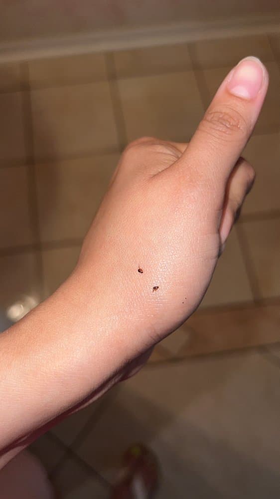 Close-up of two fleas on the back of a person's hand, showing their small size and dark reddish-brown color.